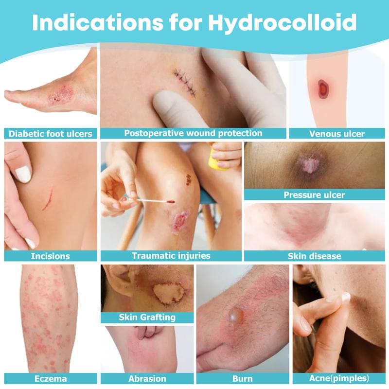 Hydrocolloid sheet roll Flexible